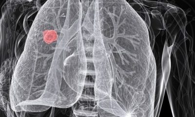 lung cancer 620x300.jpg