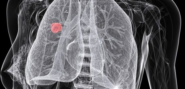 lung cancer 620x300.jpg