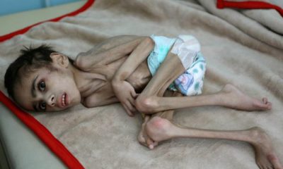 malnutrition yemen 620x350.jpg