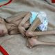 malnutrition yemen 620x350.jpg