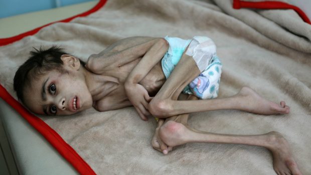 malnutrition yemen 620x350.jpg