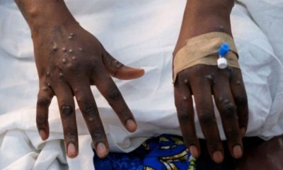 mpox patient 620x350.jpg