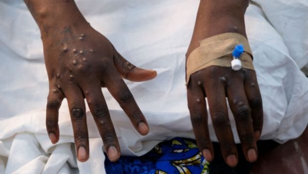 mpox patient 620x350.jpg